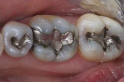 Tooth Colored Fillings