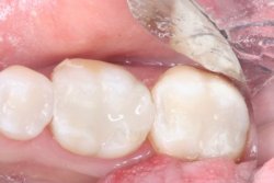 Tooth Colored Fillings