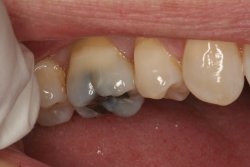 Tooth Colored Fillings