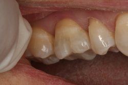 Tooth Colored Fillings