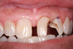 Tooth Colored Fillings