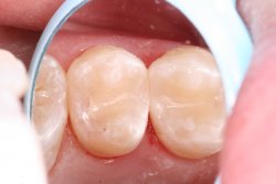 Tooth Colored Fillings