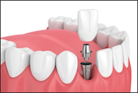 Dental Implants